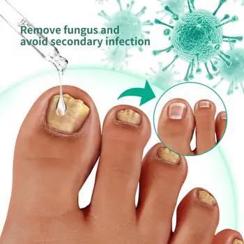 2/3/5pcs 30 ml tekućina za popravak noktiju na nogama, утолщающий tip za ruke i noge, siva, za nokte, mekana, za nokte, svijetla za čišćenje noktiju, protiv nogu